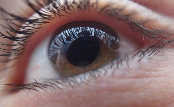 Infradiagnóstico del Glaucoma